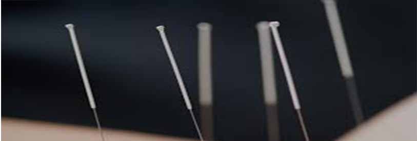 طب سوزنی از زیر مجموعه های طب سنتی است.