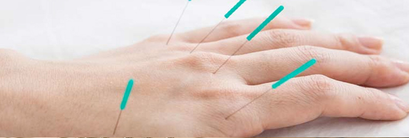 سوزن ها باید به دقت وارد پوست شوند.