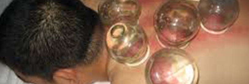 روش حجامت یکی از قدیمی ترین روش های درمان در طب سنتی است.