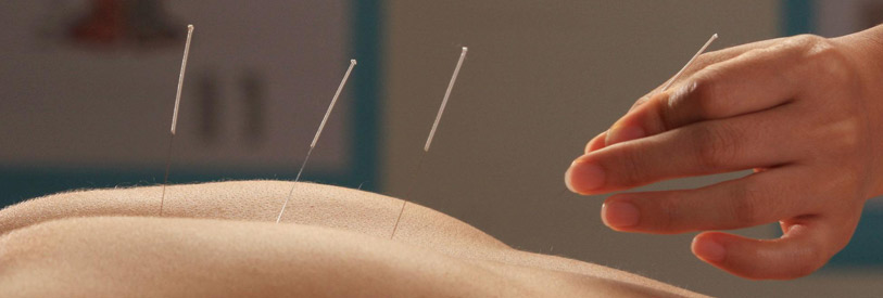 تعریف طب سوزنی