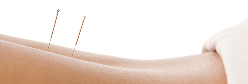 مزایای طب سوزنی